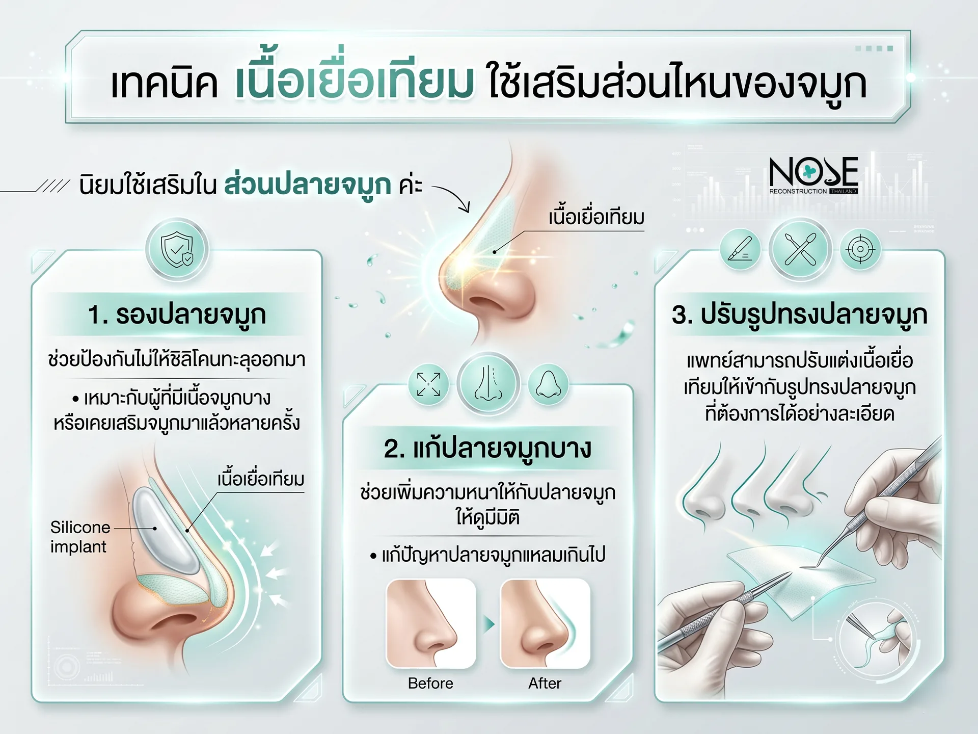 เทคนิค เนื้อเยื่อเทียม ใช้เสริมส่วนไหนของจมูก