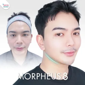Review morpheus8 6