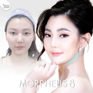 Review morpheus8 6