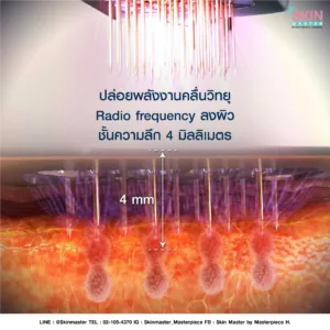 ปล่อยพลังงานคลื่นวิทยุ Radio frequency ลงผิว
