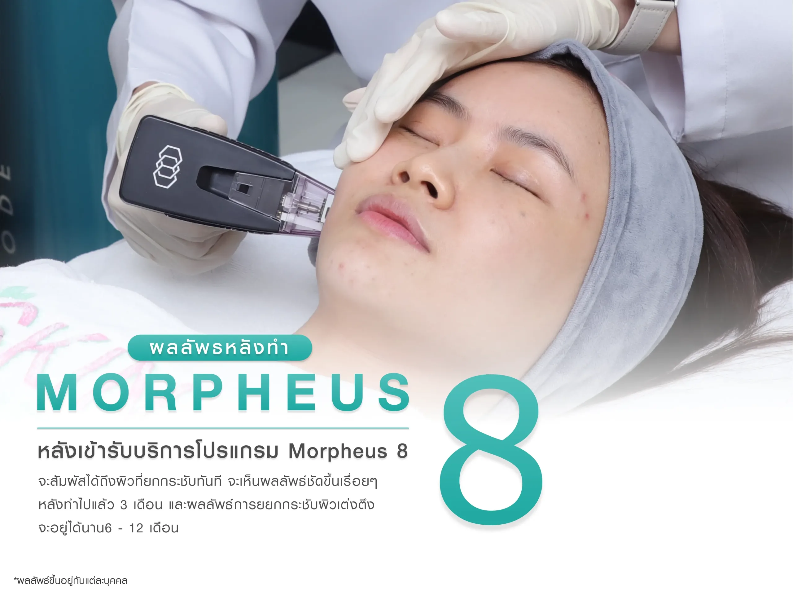 ผลลัพธ์หลังทำ มอเฟียส 8 ( MORPHEUS8 ) ผลลัพธ์หลังทำ มอเฟียส 8 ( MORPHEUS8 )