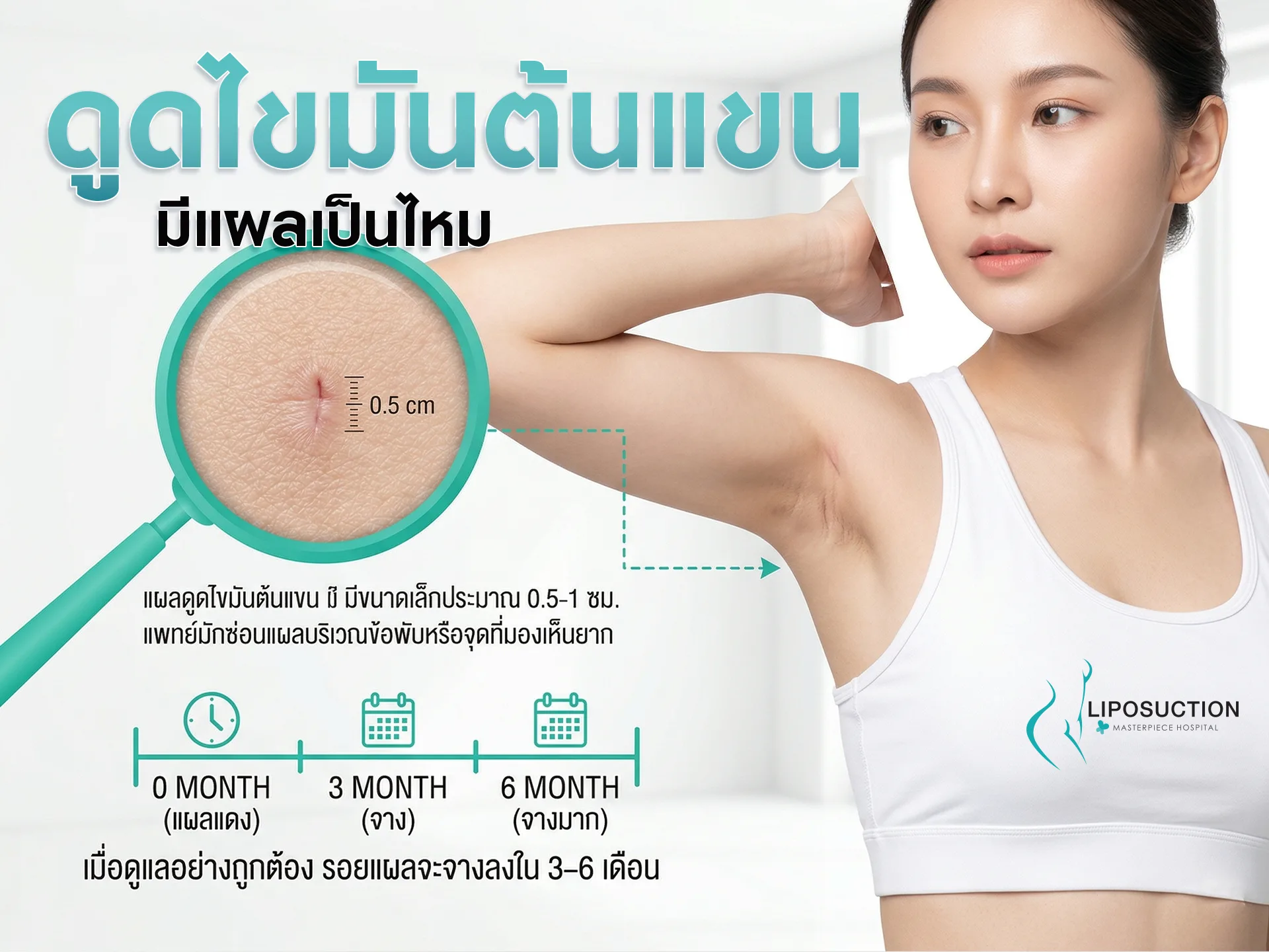 ดูดไขมันต้นแขนมีแผลเป็นไหม