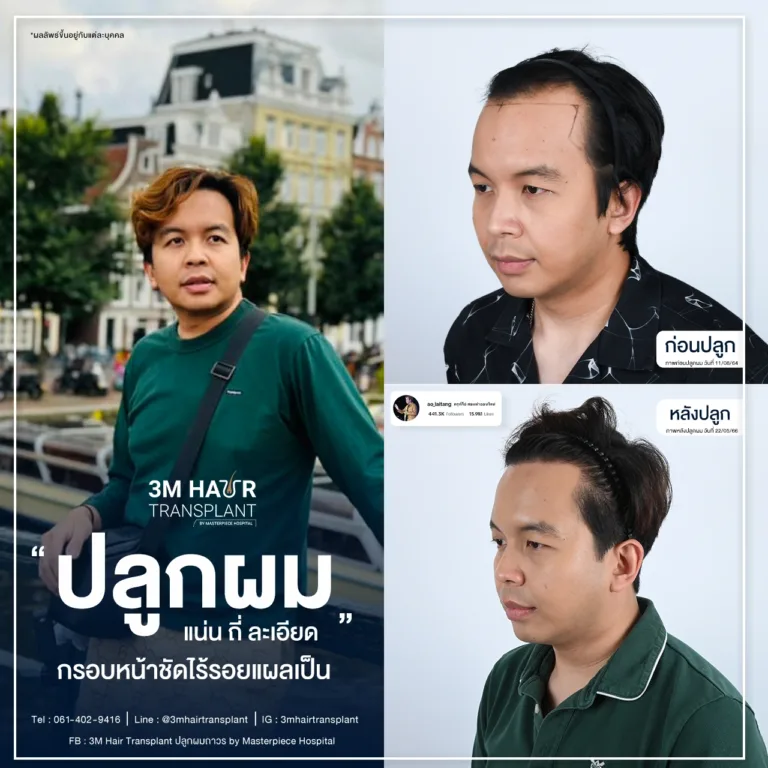 ปลูกผม แก้ปัญหาศีรษะล้าน ผมบาง ทำให้ผมหนาขึ้น
