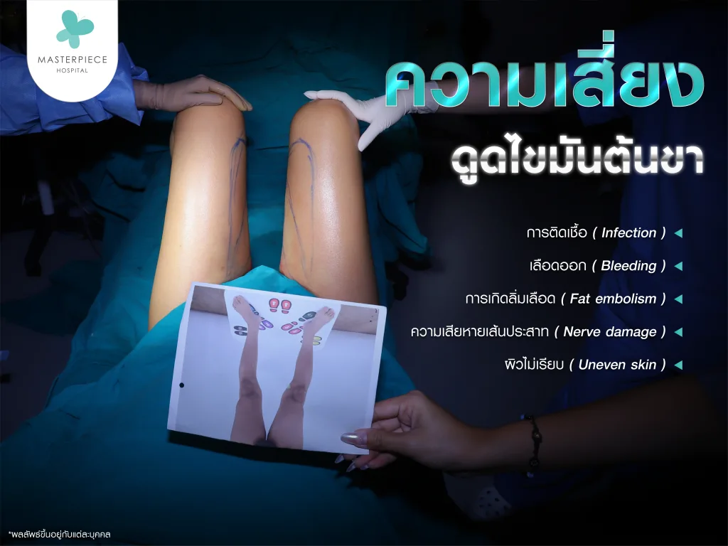 ความเสี่ยงและผลข้างเคียงการดูดไขมันต้นขา