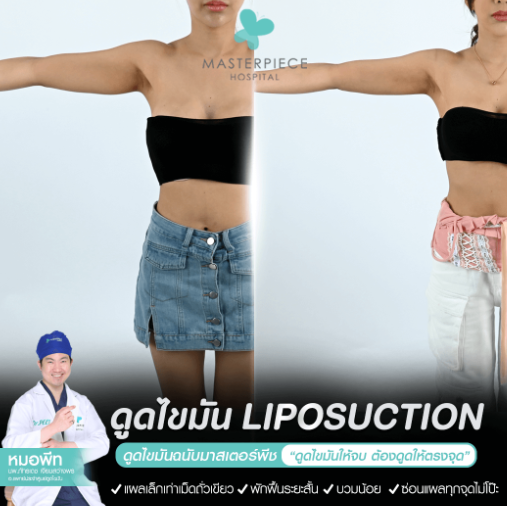 รีวิวบริการดูดไขมันต้นแขน รีวิวบริการดูดไขมันต้นแขน