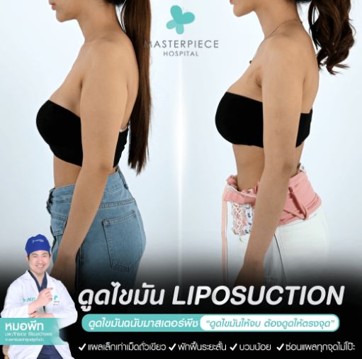 รีวิวบริการดูดไขมันต้นแขน รีวิวบริการดูดไขมันต้นแขน
