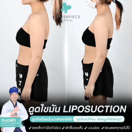 รีวิวบริการดูดไขมันต้นแขน รีวิวบริการดูดไขมันต้นแขน