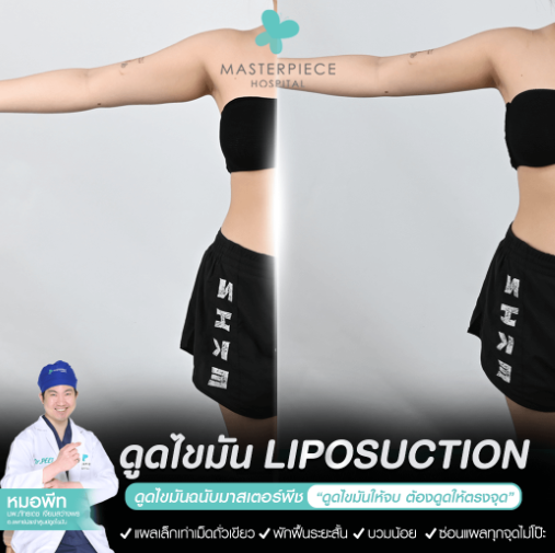 รีวิวบริการดูดไขมันต้นแขน รีวิวบริการดูดไขมันต้นแขน