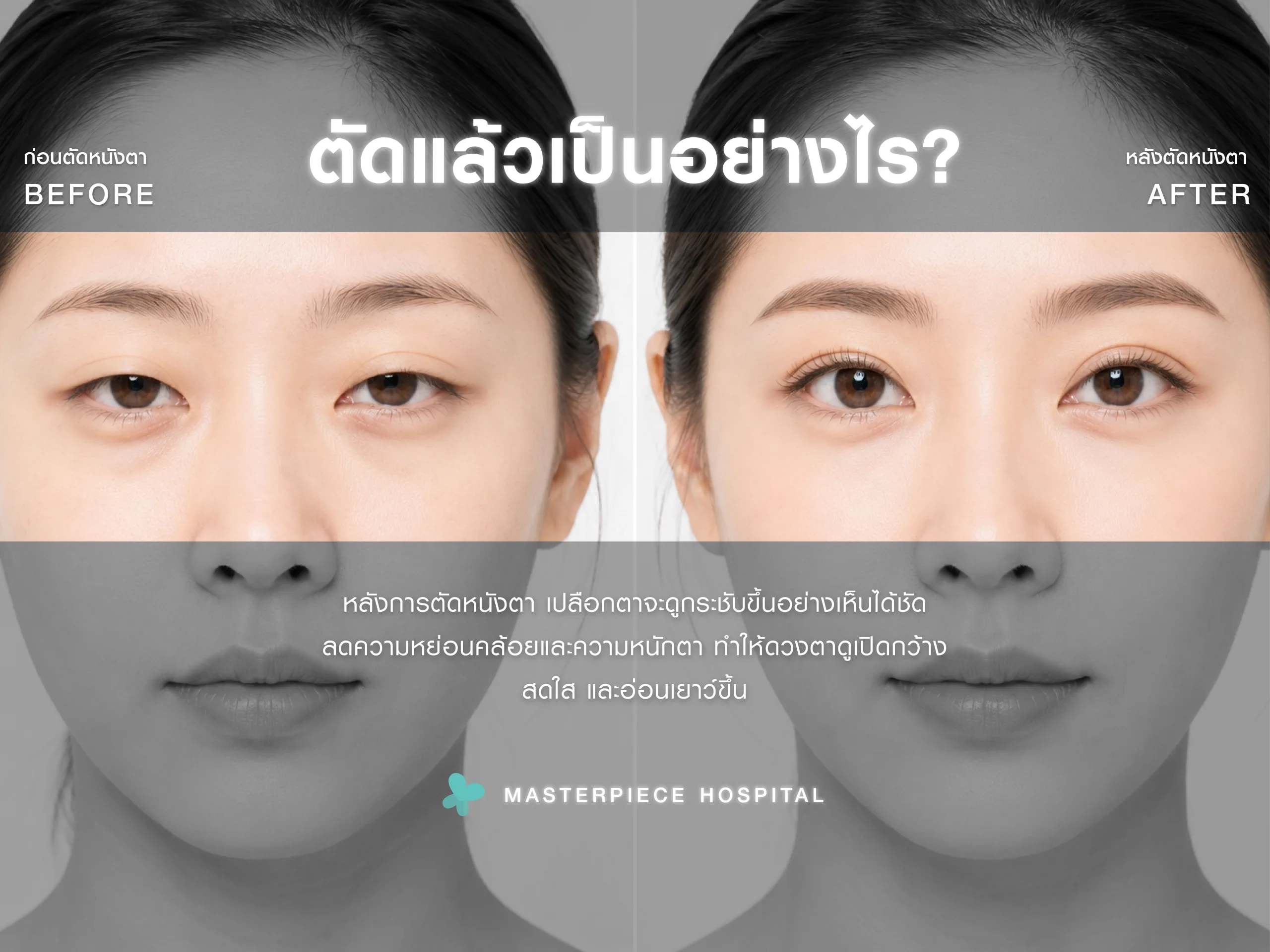 ตัดหนังตาแล้วเป็นอย่างไร?