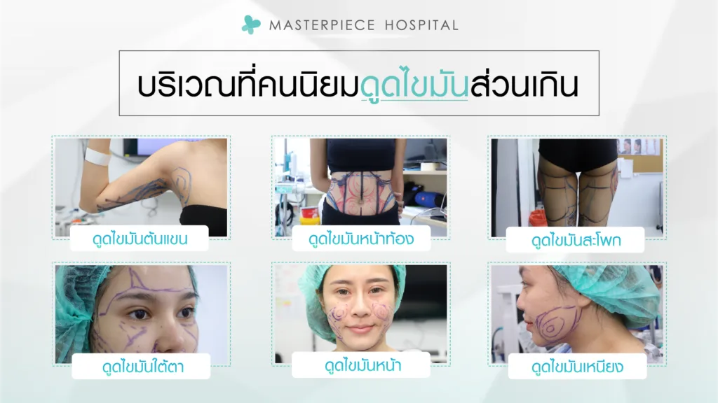 ตำแหน่งยอดนิยมการดูดไขมัน ตำแหน่งยอดนิยมการดูดไขมัน
