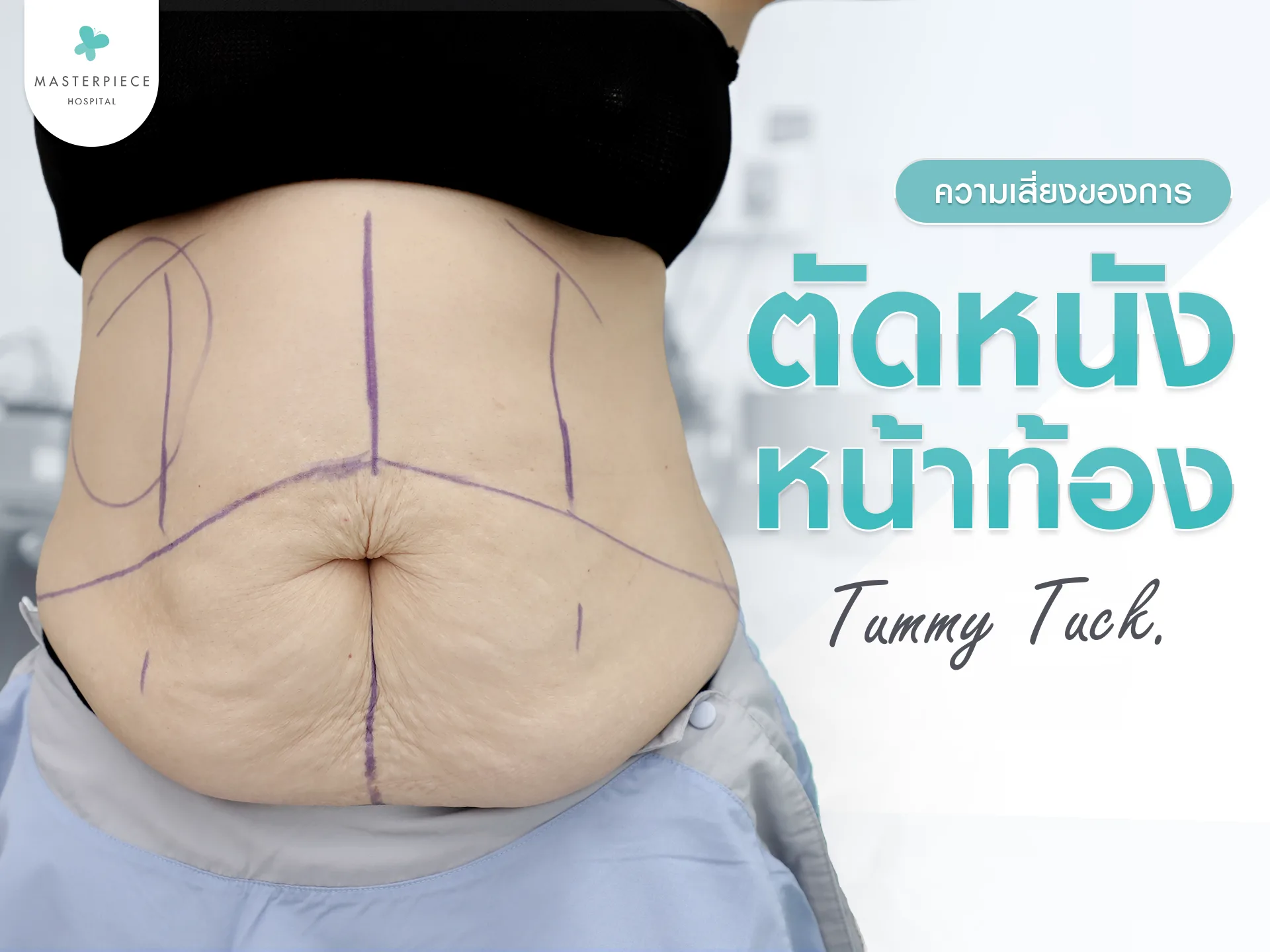 ประโยชน์และความเสี่ยงของการ ตัดหนังหน้าท้อง