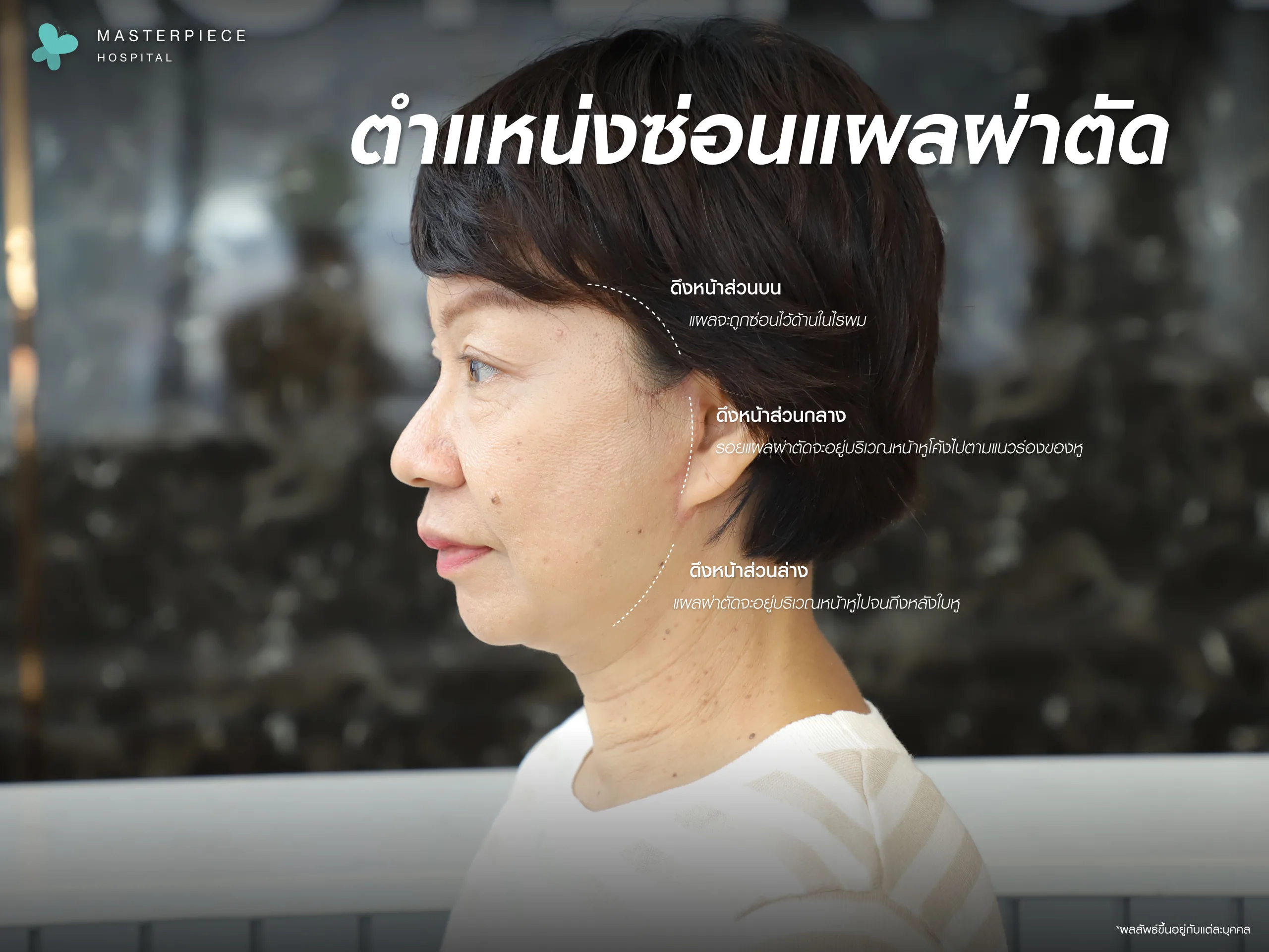 ดึงหน้า Face Lift คืออะไร อันตรายไหม ราคาเท่าไหร่