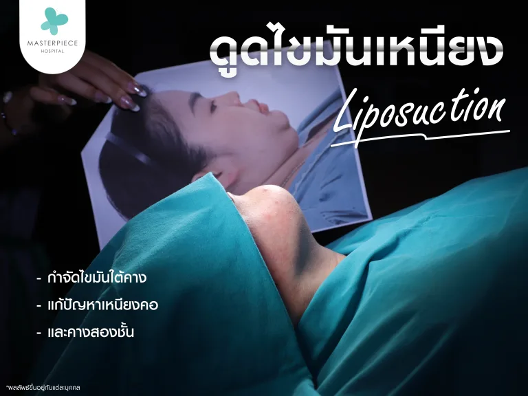ดูดไขมันเหนียง กำจัดไขมันใต้คาง แก้ปัญหาเหนียงคอ และคางสองชั้น