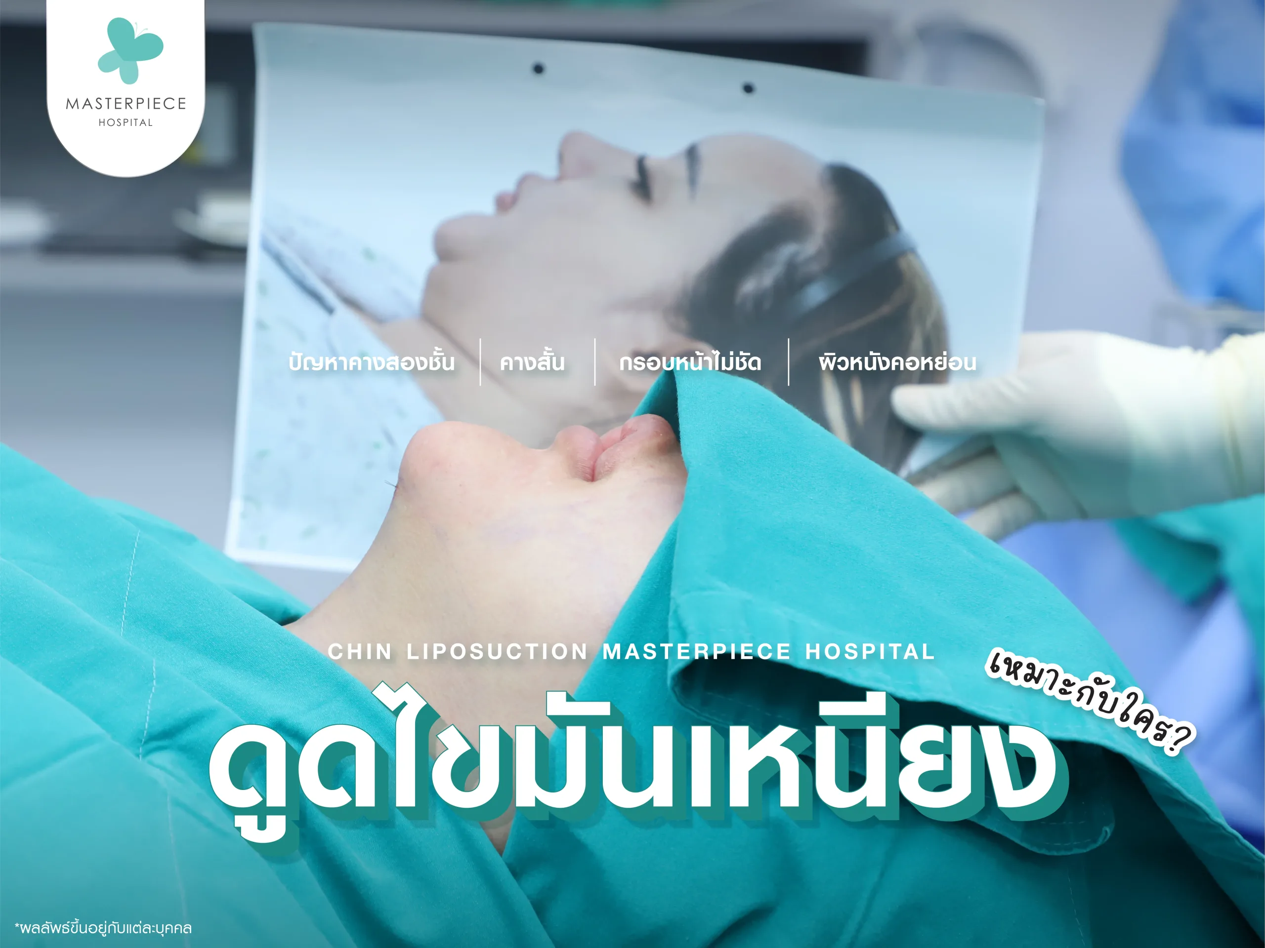 ดูดไขมันเหนียง เหมาะกับใคร?