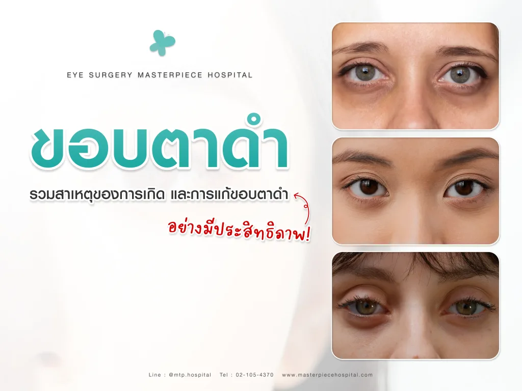 รวมสาเหตุของการเกิดขอบตาดำ และการแก้ขอบตาดำอย่างมีประสิทธิภาพ