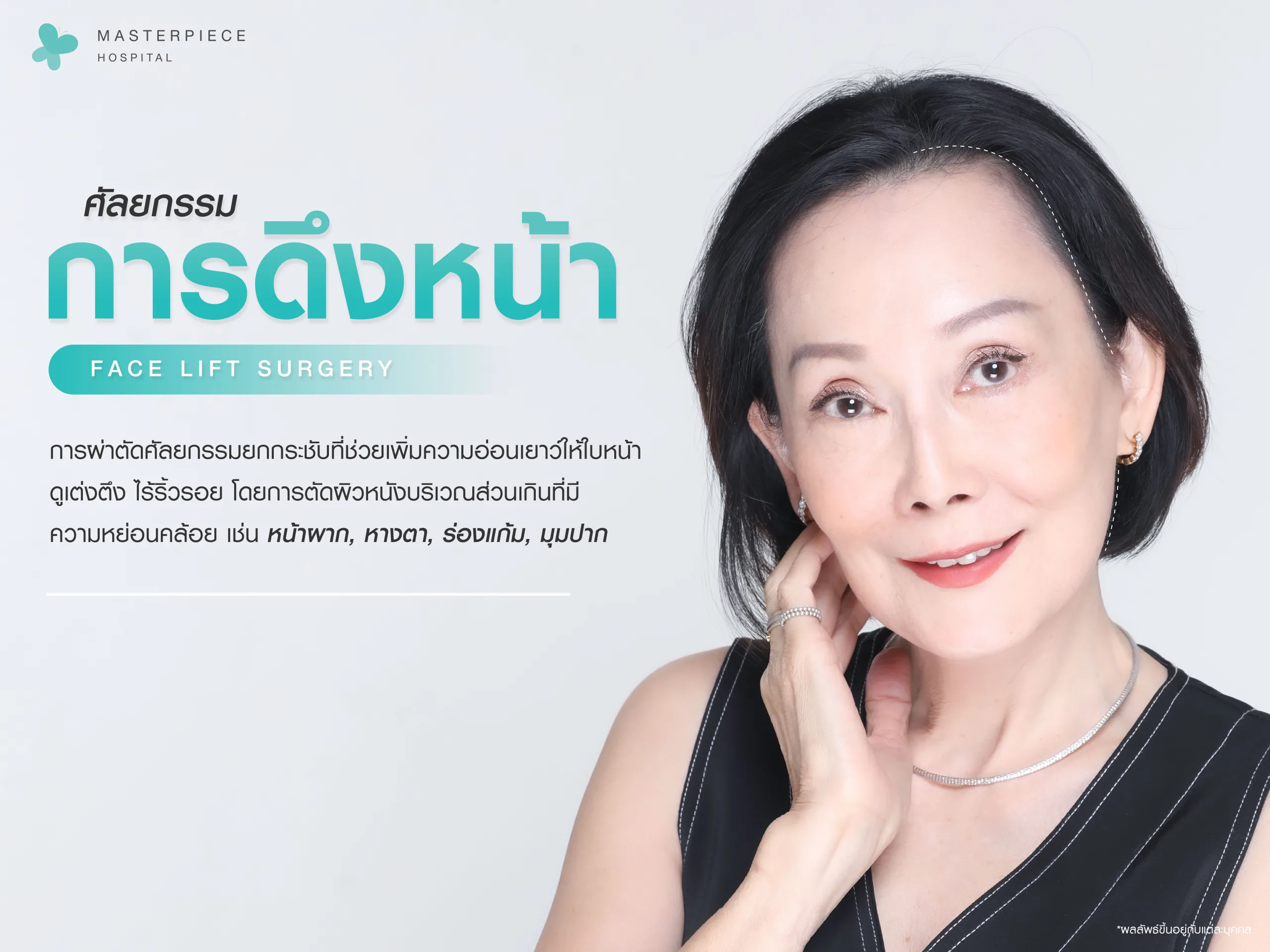 ดึงหน้า (Face Lift) คืออะไร ?