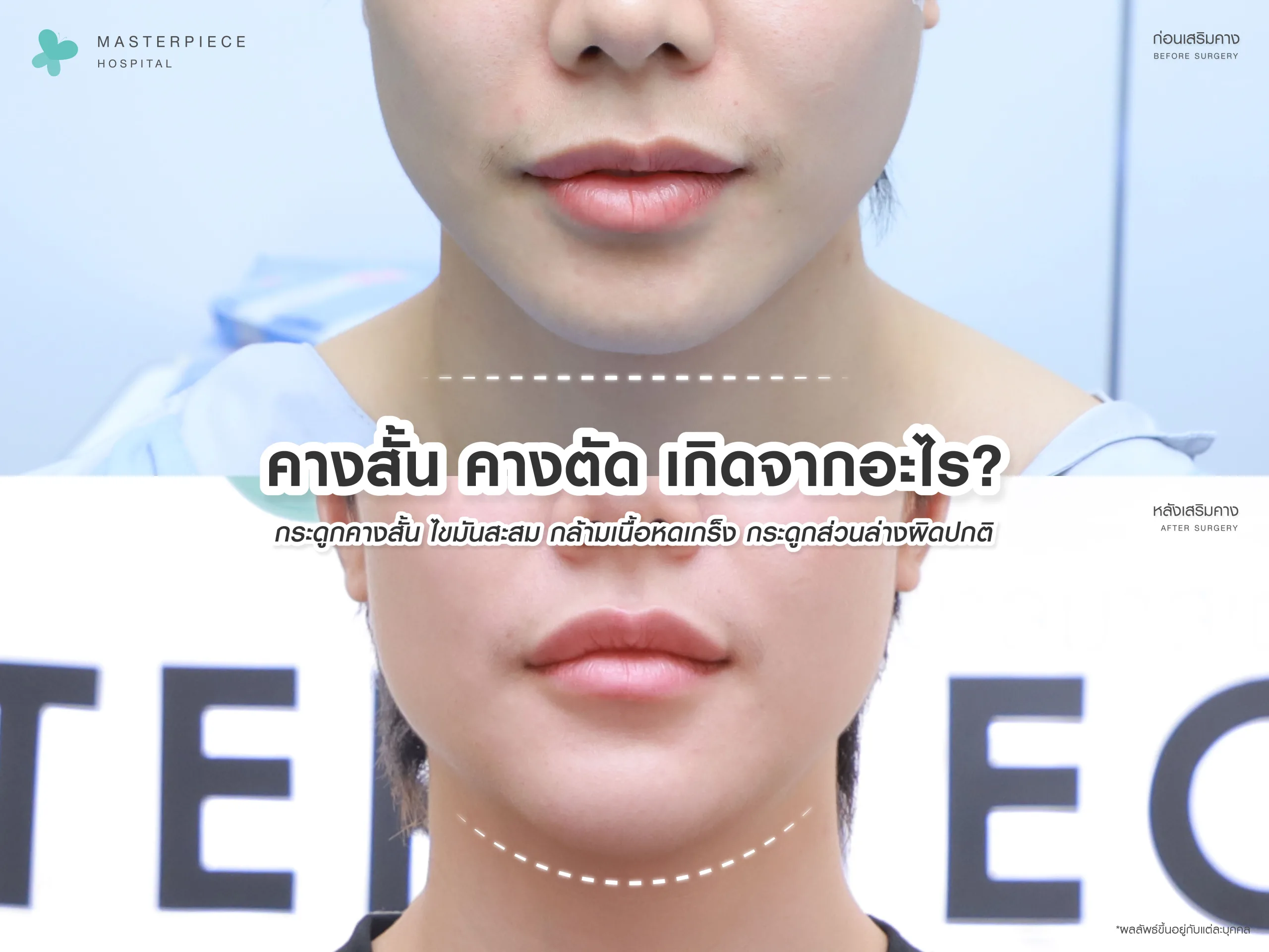 คางสั้น คางตัด เกิดจากอะไร?