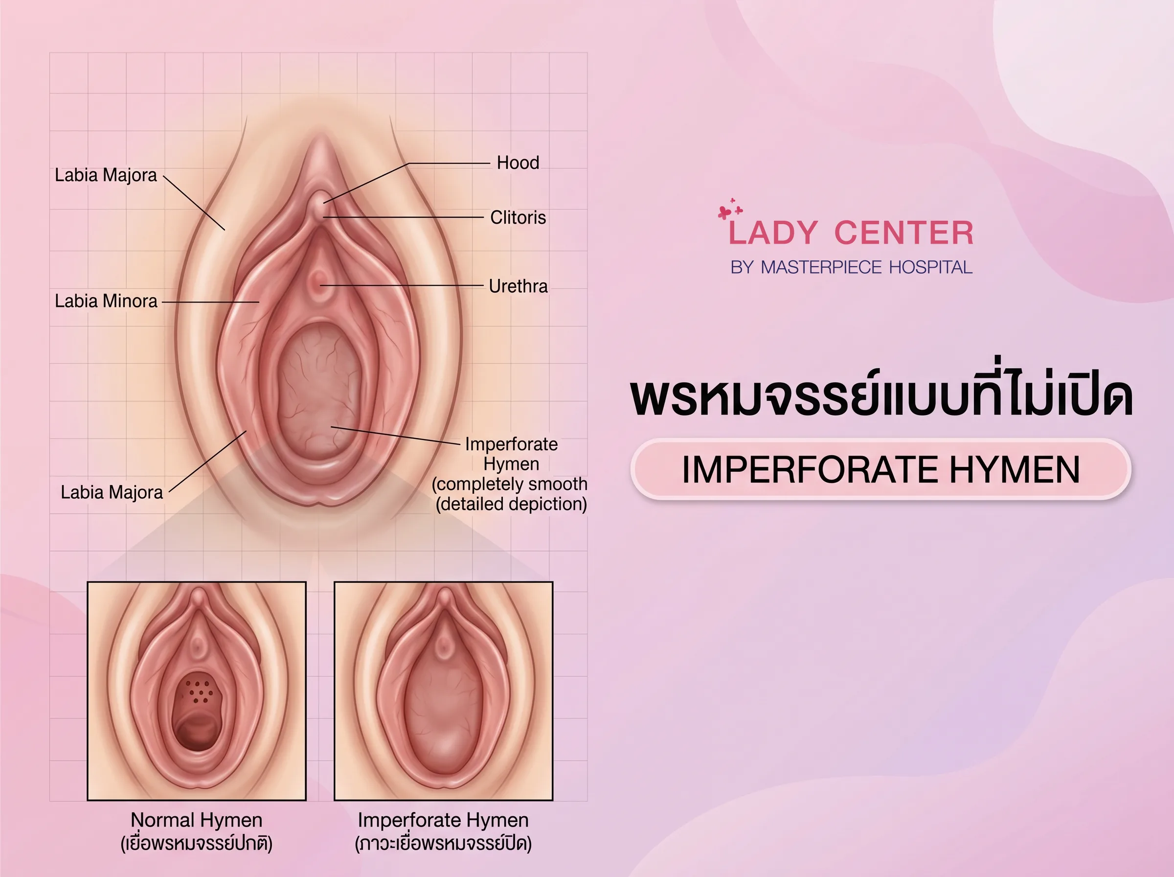 เยื่อพรหมจรรย์แบบที่ไม่เปิด (Imperforate Hymen)