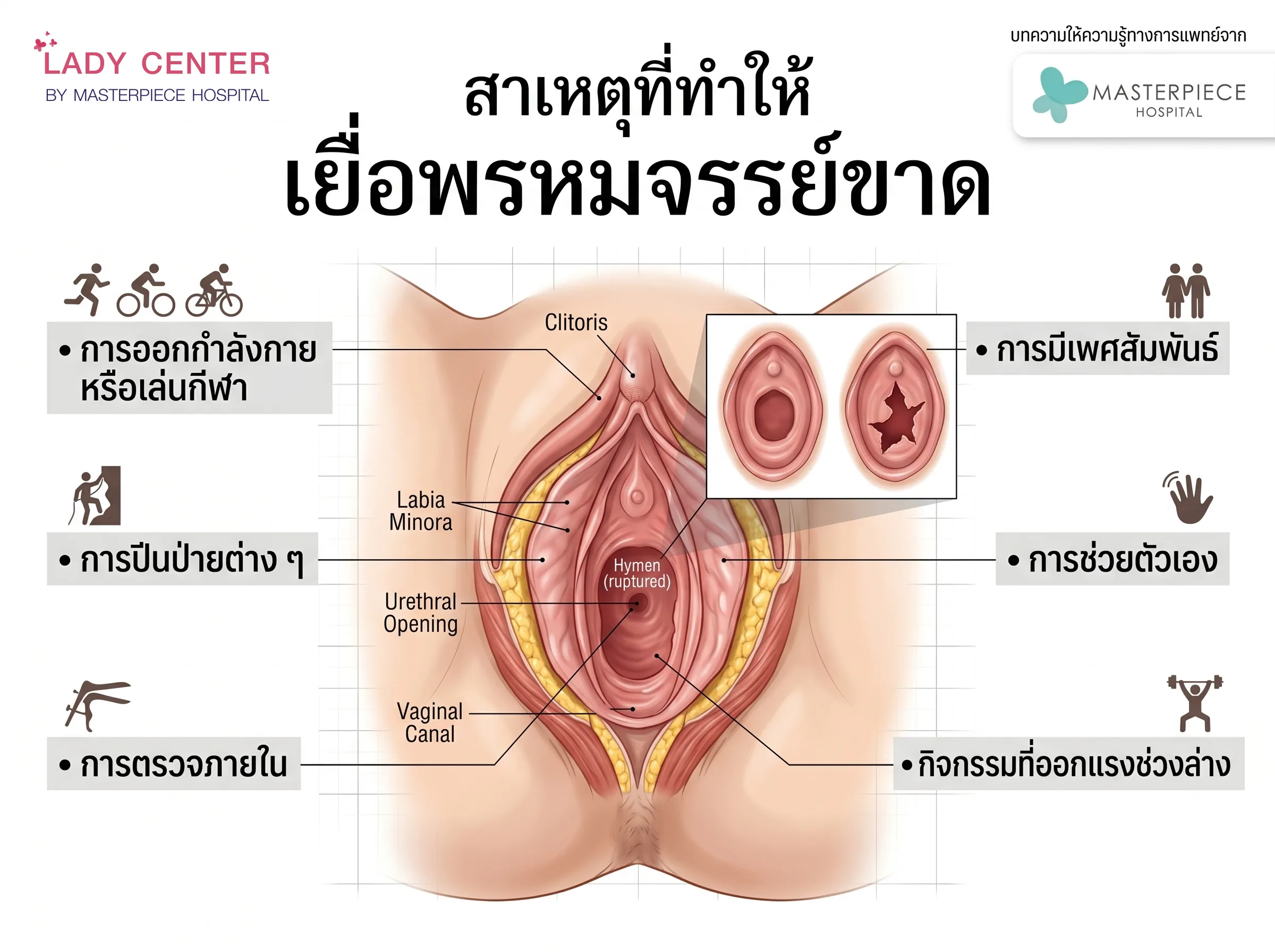 สาเหตุที่ทำให้เยื่อพรหมจรรย์ขาด