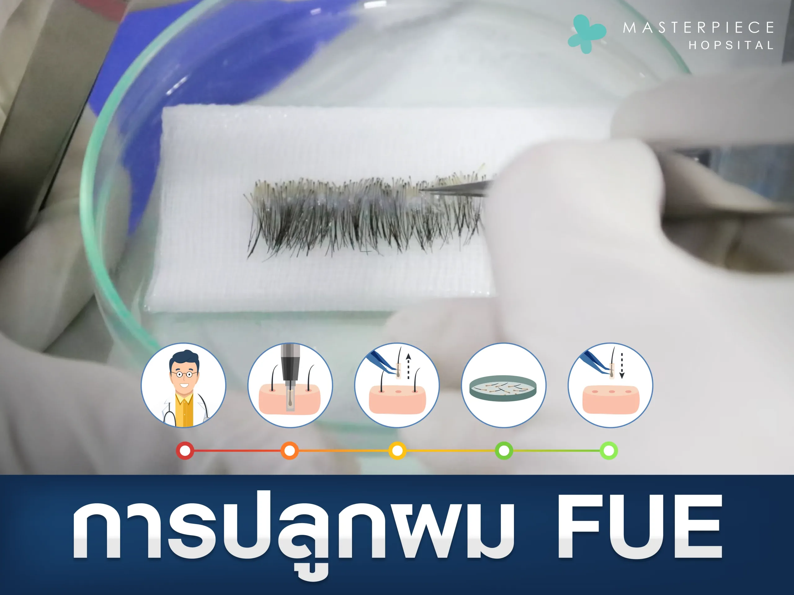 การปลูกผมแบบ FUE