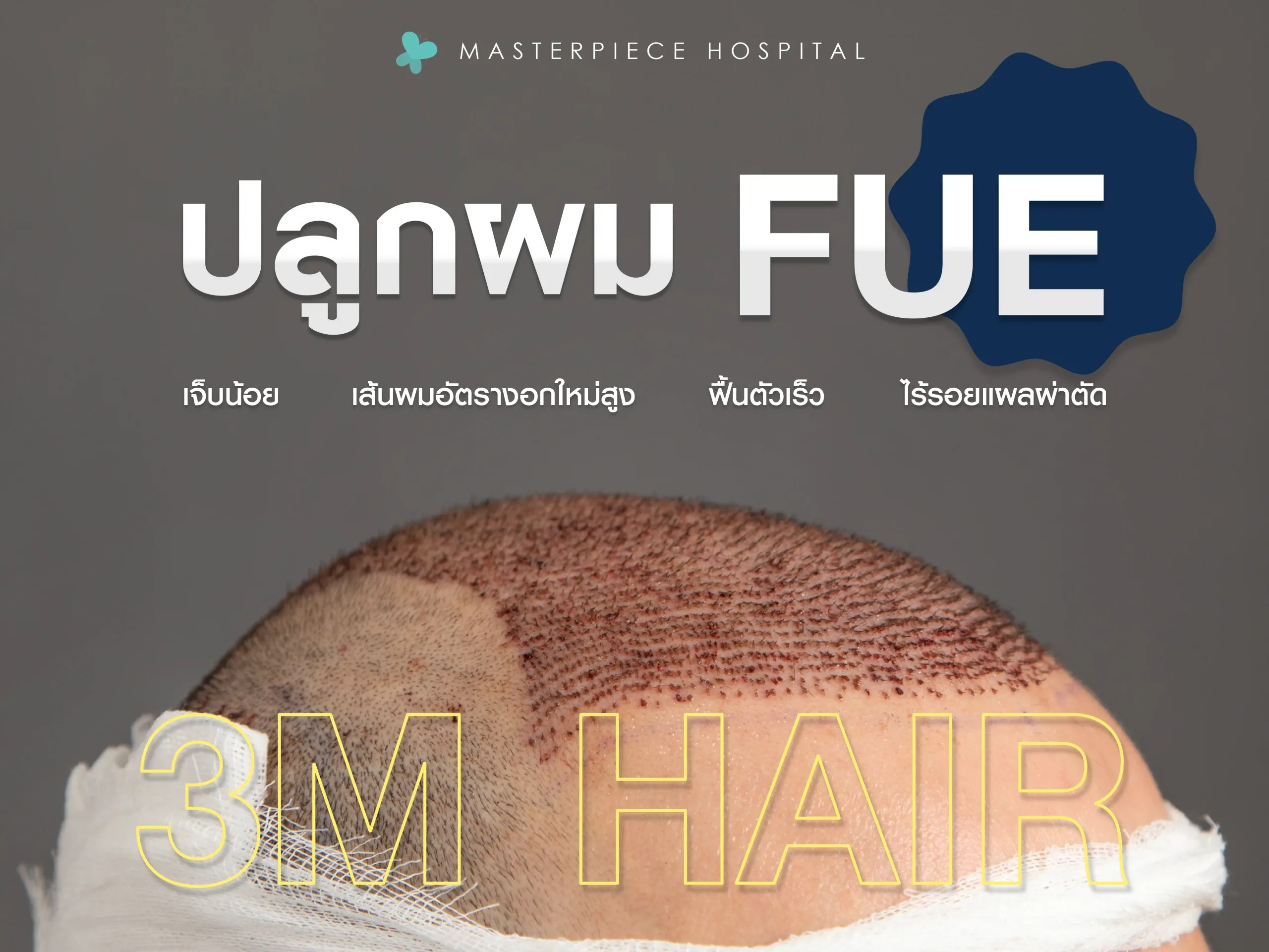 ข้อดีของการปลูกผมแบบ FUE