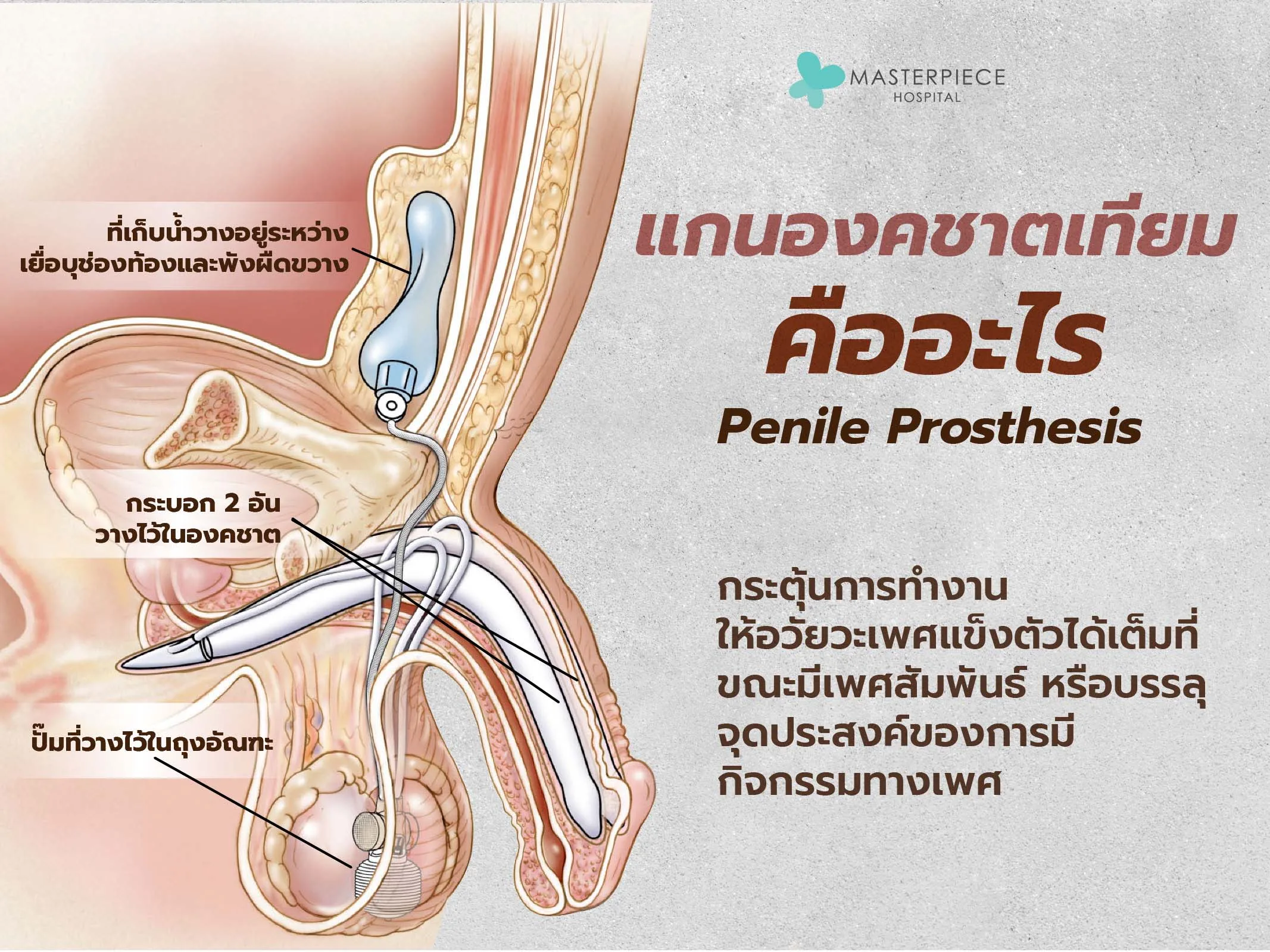 องคชาติเทียมคืออะไร