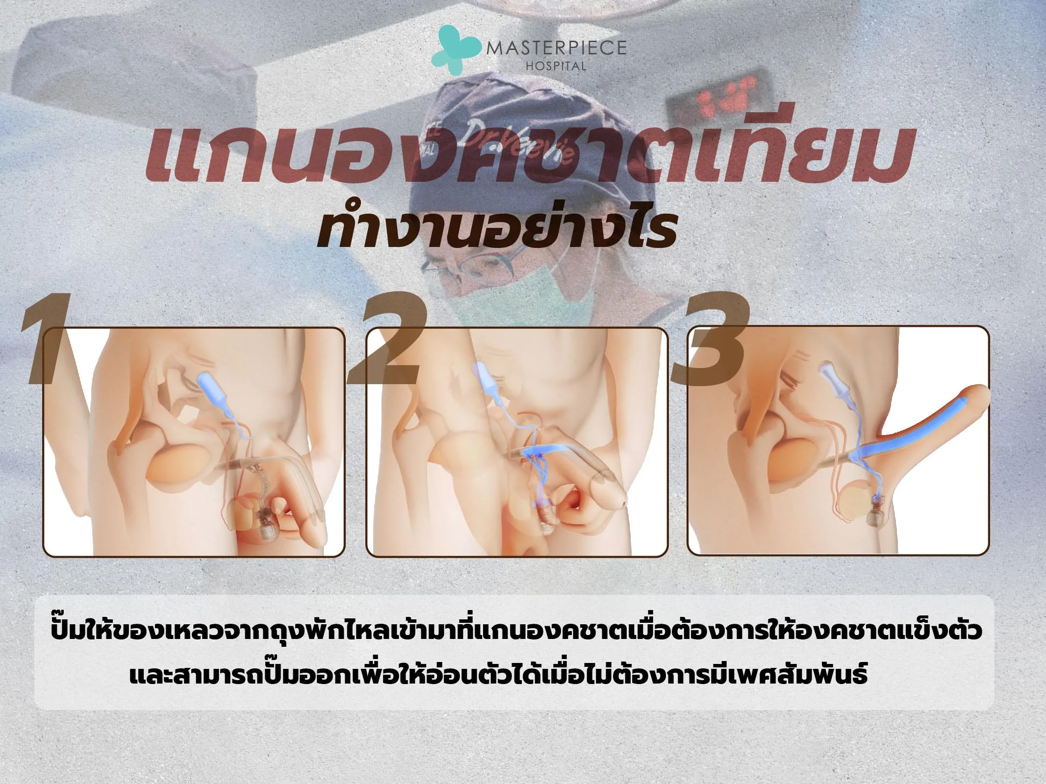 องคชาติเทียมทำงานอย่างไร