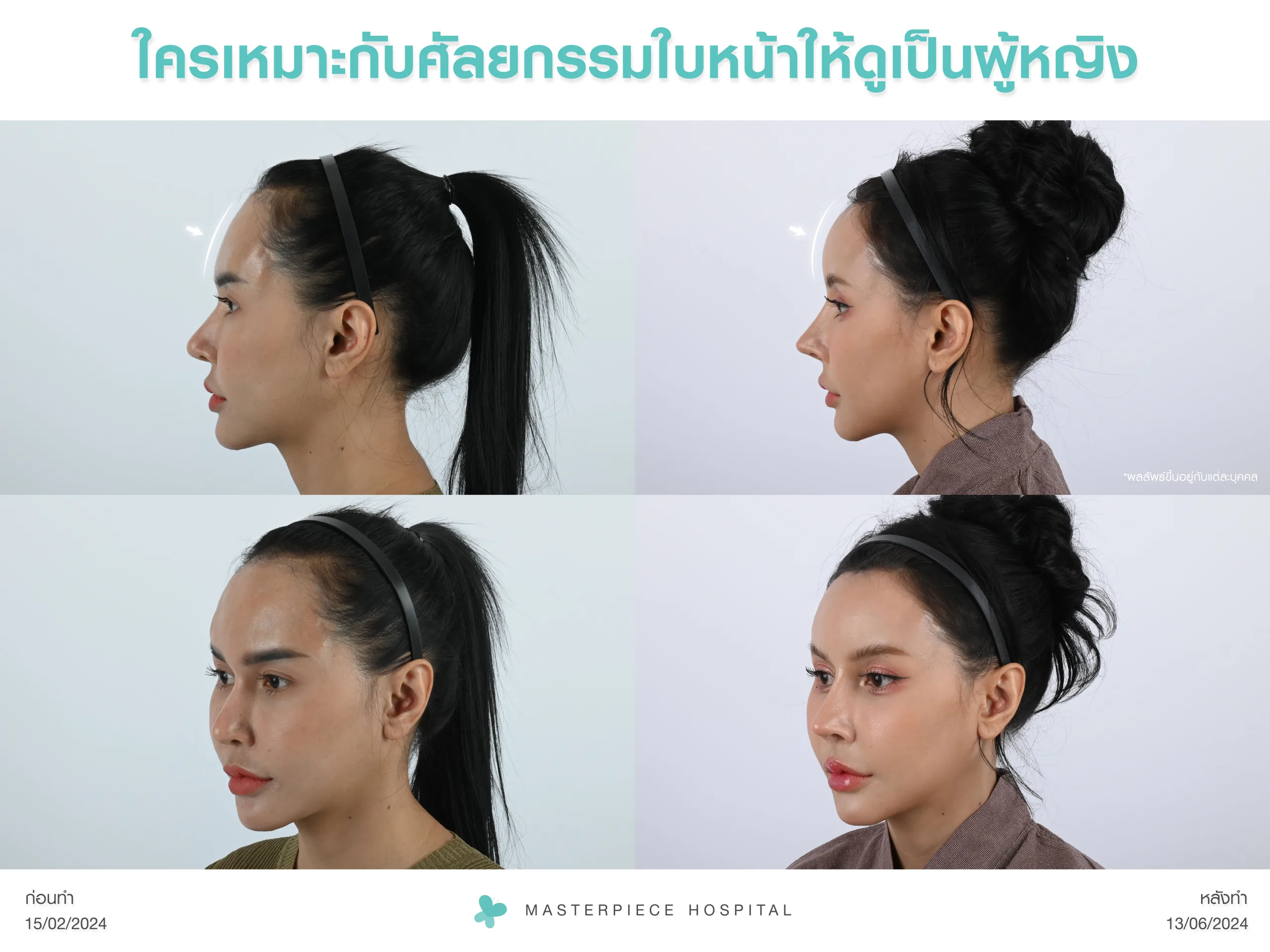 ใครที่เหมาะกับการศัลยกรรมใบหน้าให้ดูเป็นผู้หญิง?