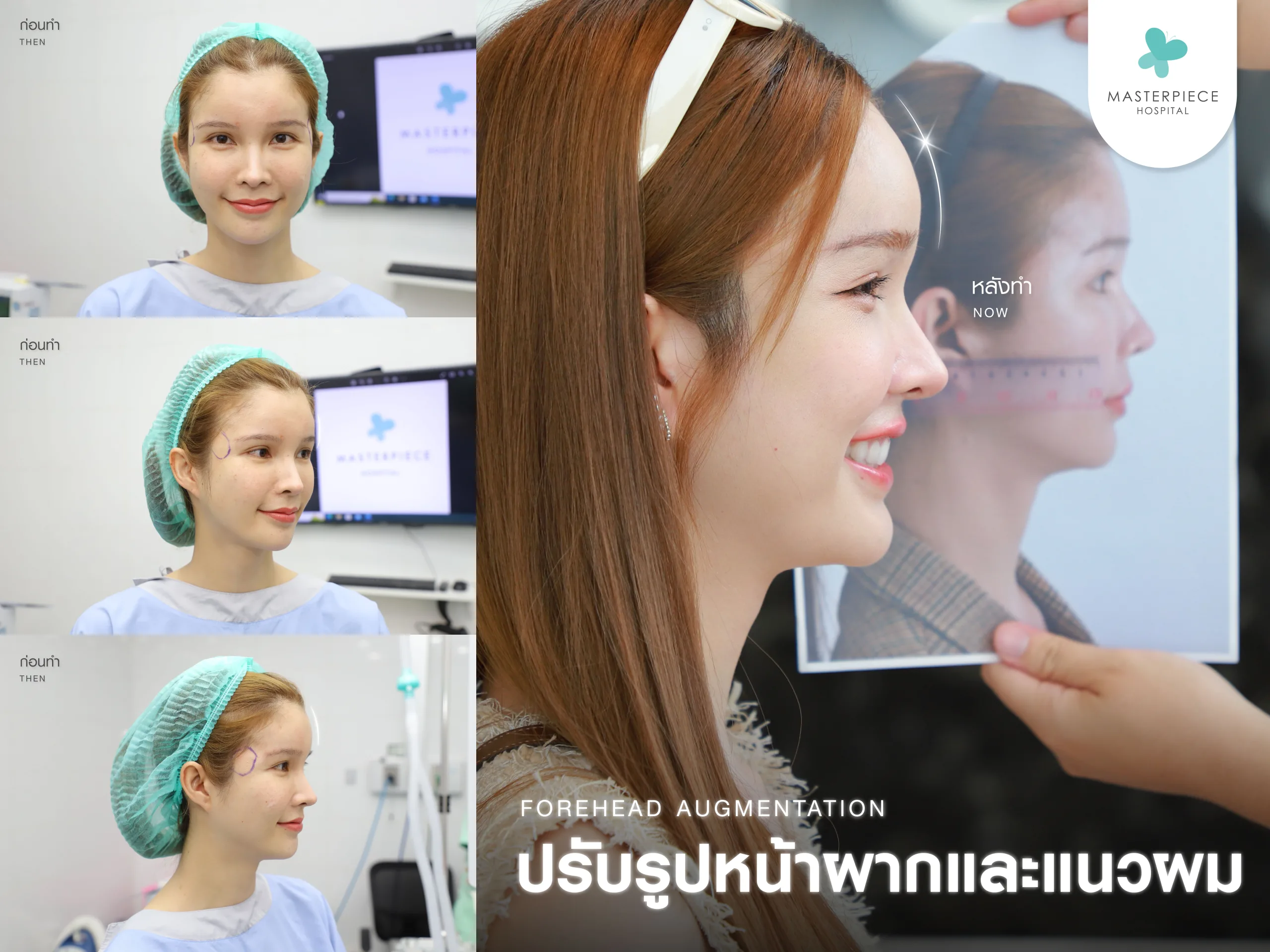 การปรับรูปหน้าผากและแนวผม