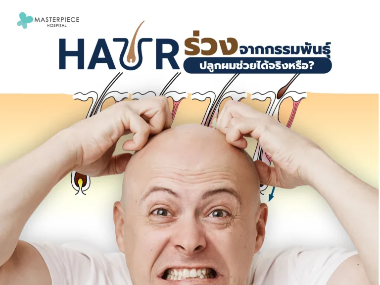 ผมร่วงจากกรรมพันธุ์ เข้าใจสาเหตุ อาการ การปลูกผมช่วยได้จริงหรือ?