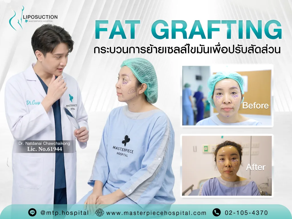การเติมไขมัน (Fat Grafting) กระบวนการย้ายเซลล์ไขมันเพื่อปรับสัดส่วน