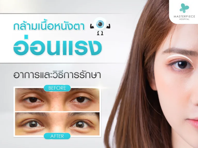 กล้ามเนื้อตาอ่อนแรงเกิดจากอะไรได้บ้าง มีอาการอย่างไร รวมไปถึงวิธีการรักษา