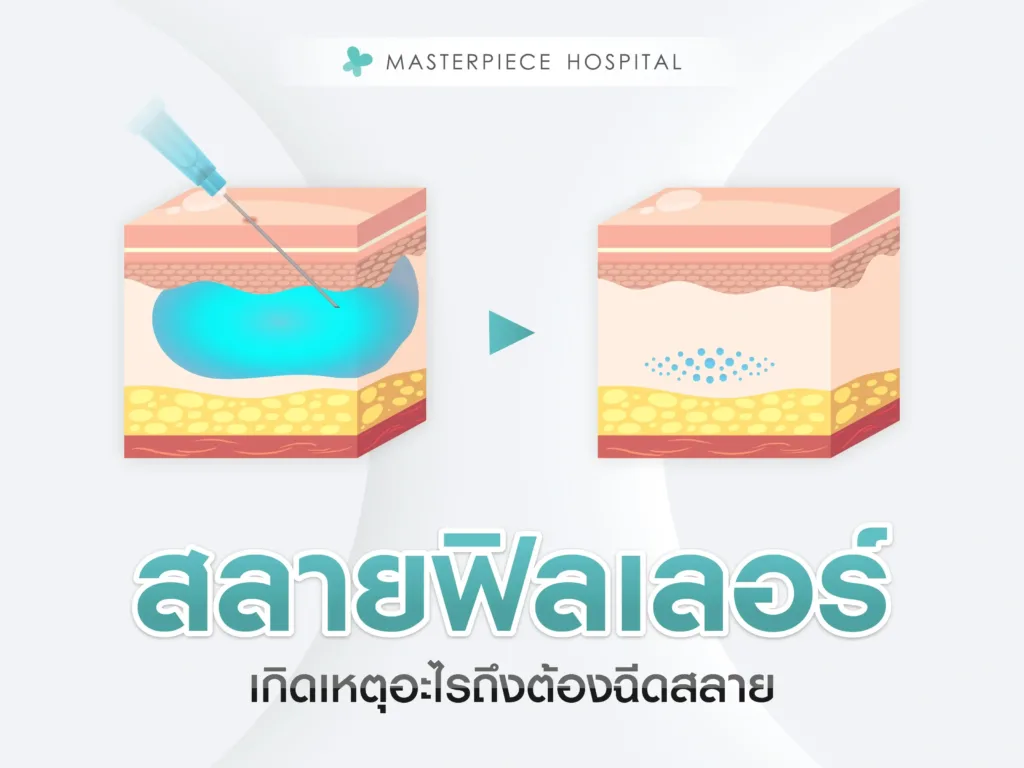 ฉีดสลายฟิลเลอร์คืออะไร เกิดเหตุอะไรถึงต้องฉีดสลาย