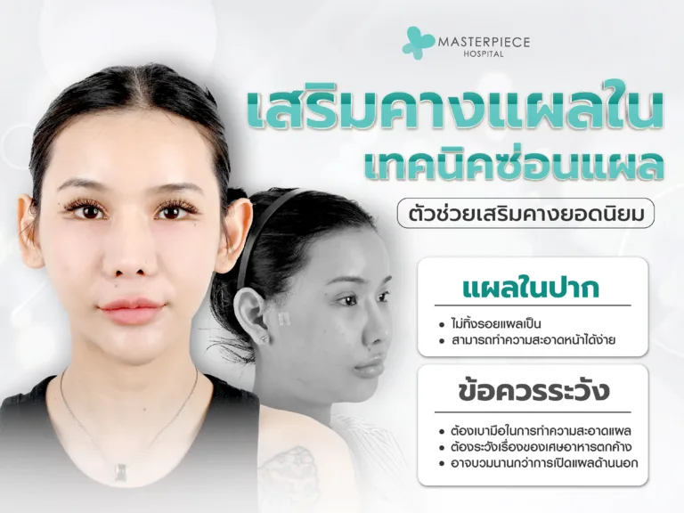 เสริมคางแผลใน เทคนิคซ่อนแผล ตัวช่วยเสริมคางยอดนิยม