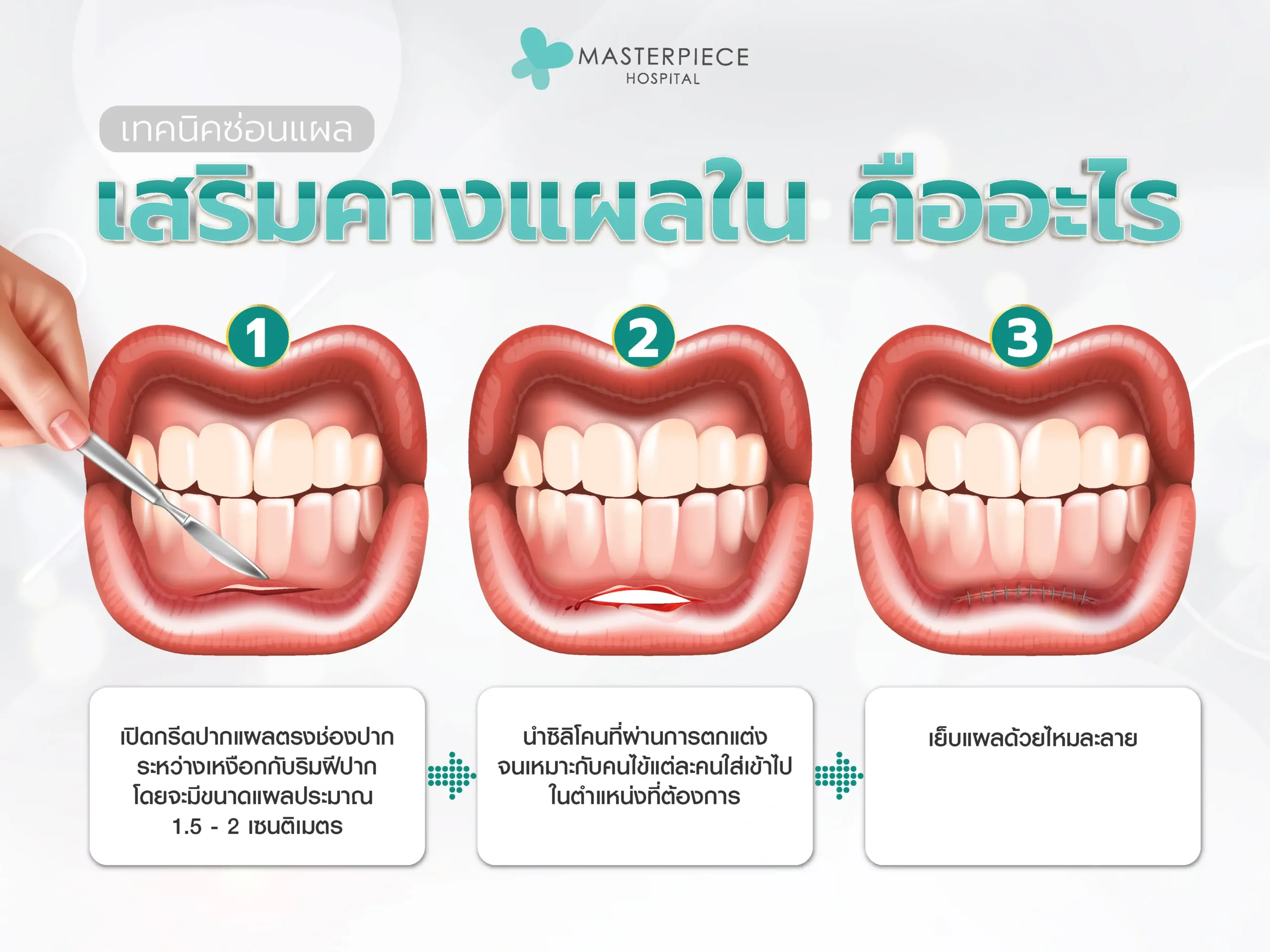 เสริมคางแผลใน คืออะไร