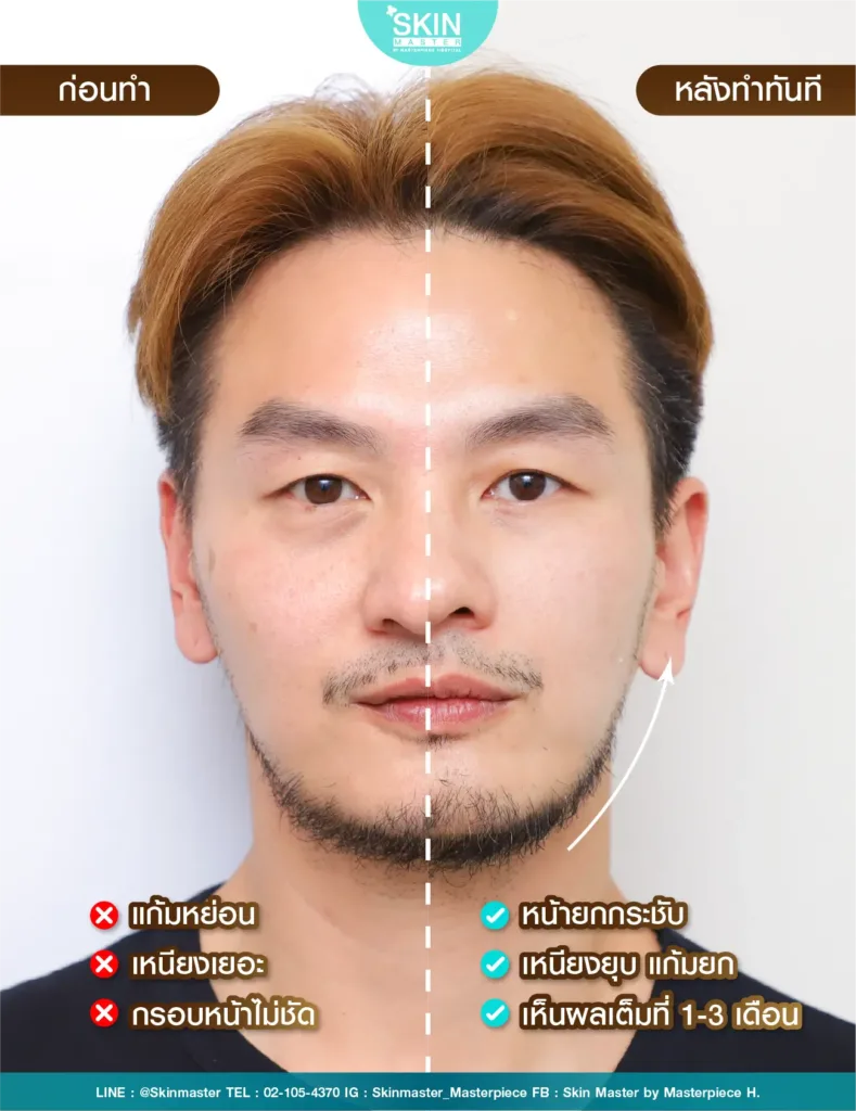รีวิว ultherapy