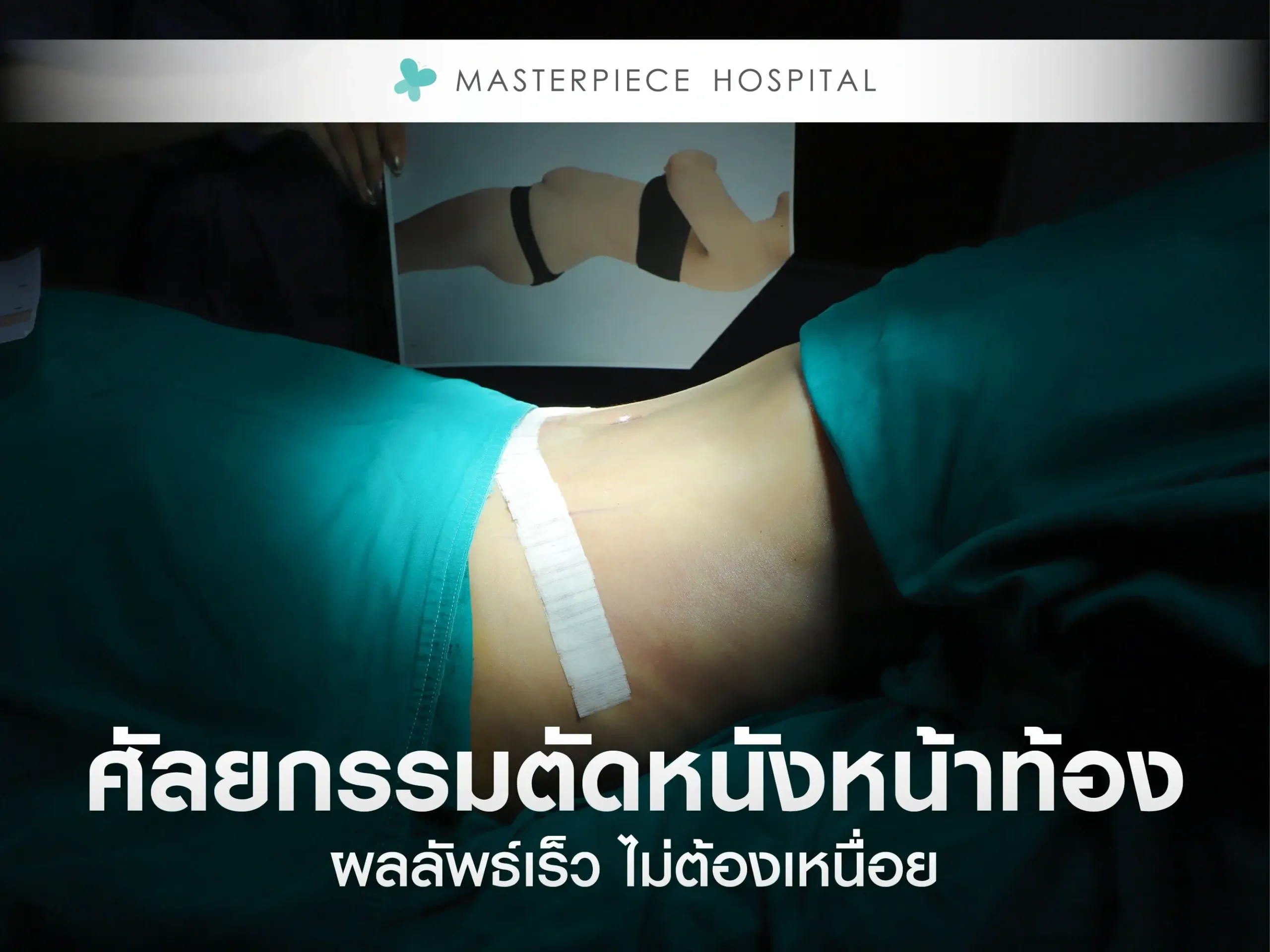 ศัลยกรรมตัดหนังหน้าท้อง ทางเลือกสำหรับผู้ที่ต้องการเห็นผลลัพธ์เร็ว ไม่ต้องเหนื่อย