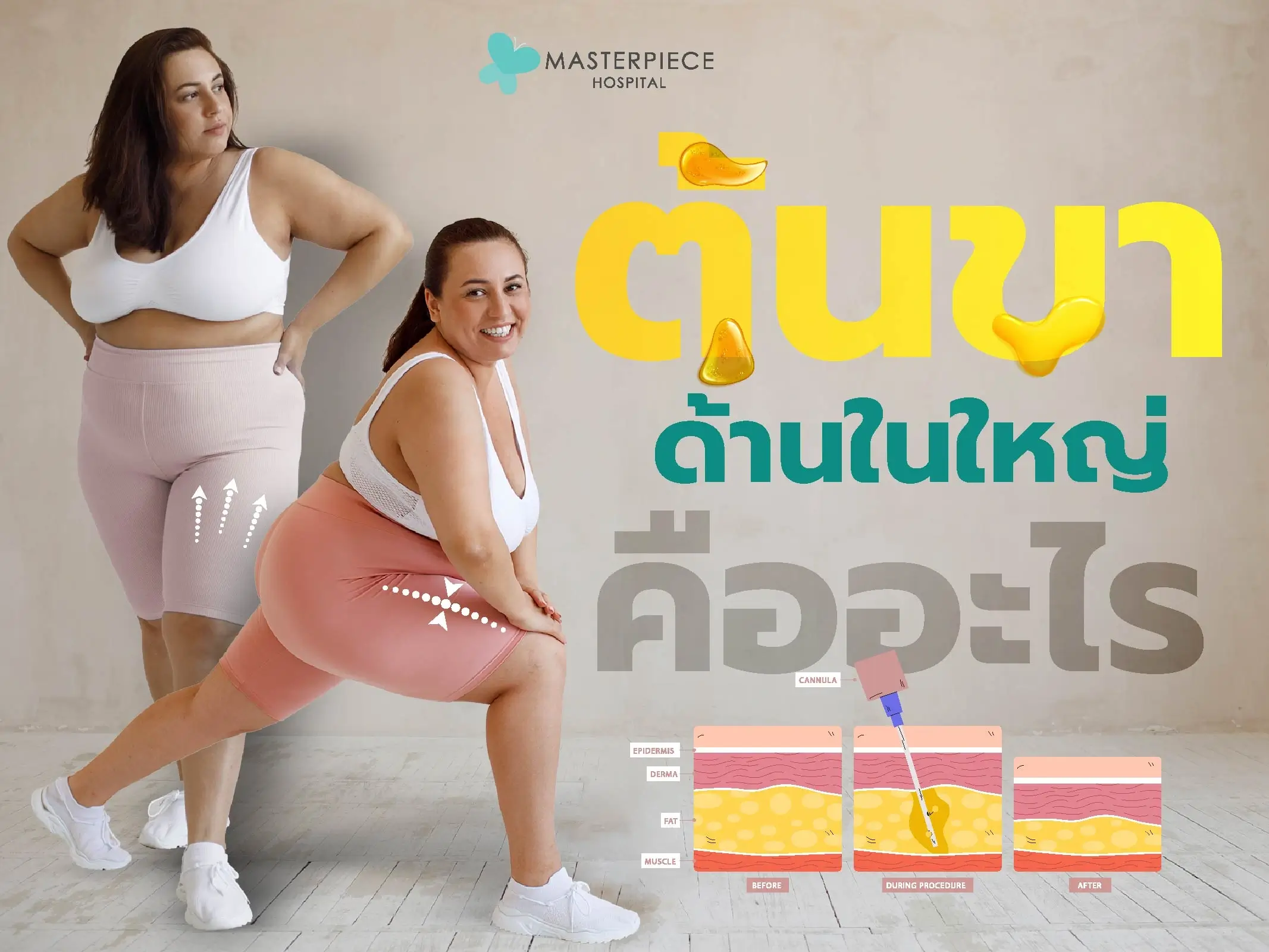 ต้นขาด้านในใหญ่คืออะไร?