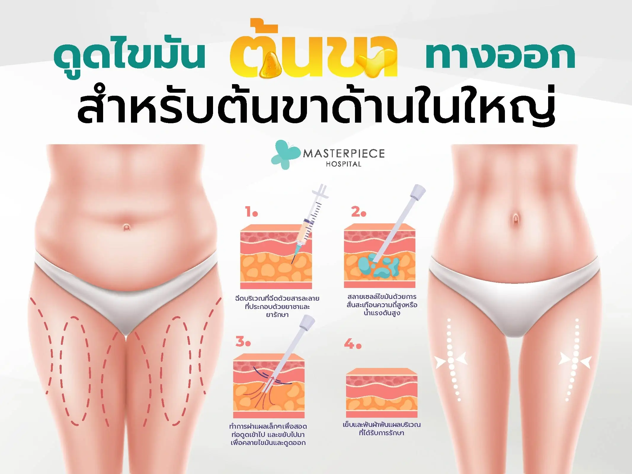 ดูดไขมันต้นขา ทางออกสำหรับต้นขาด้านในใหญ่