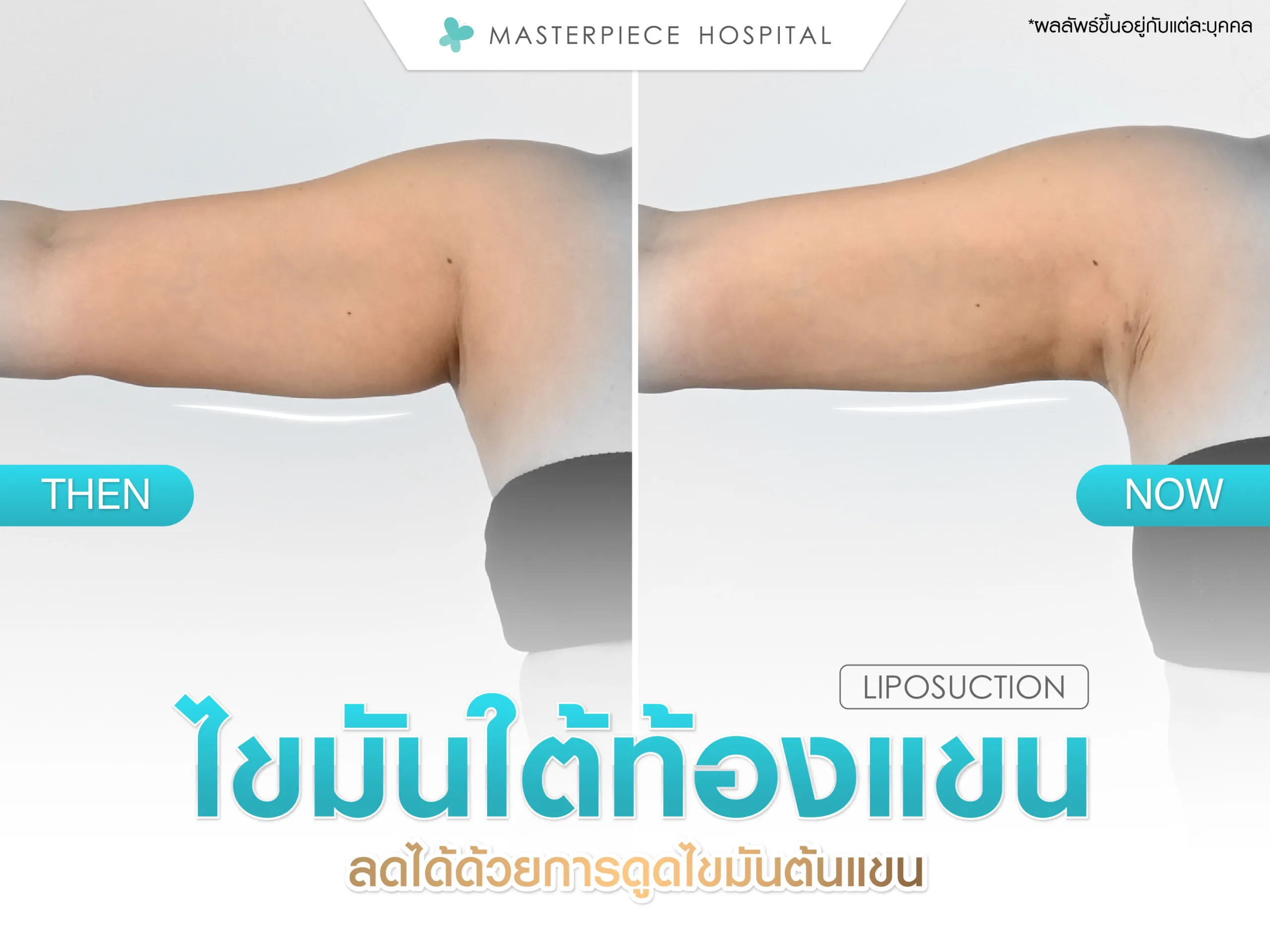 ไขมันใต้ท้องแขนลดได้ด้วยการดูดไขมันต้นแขน