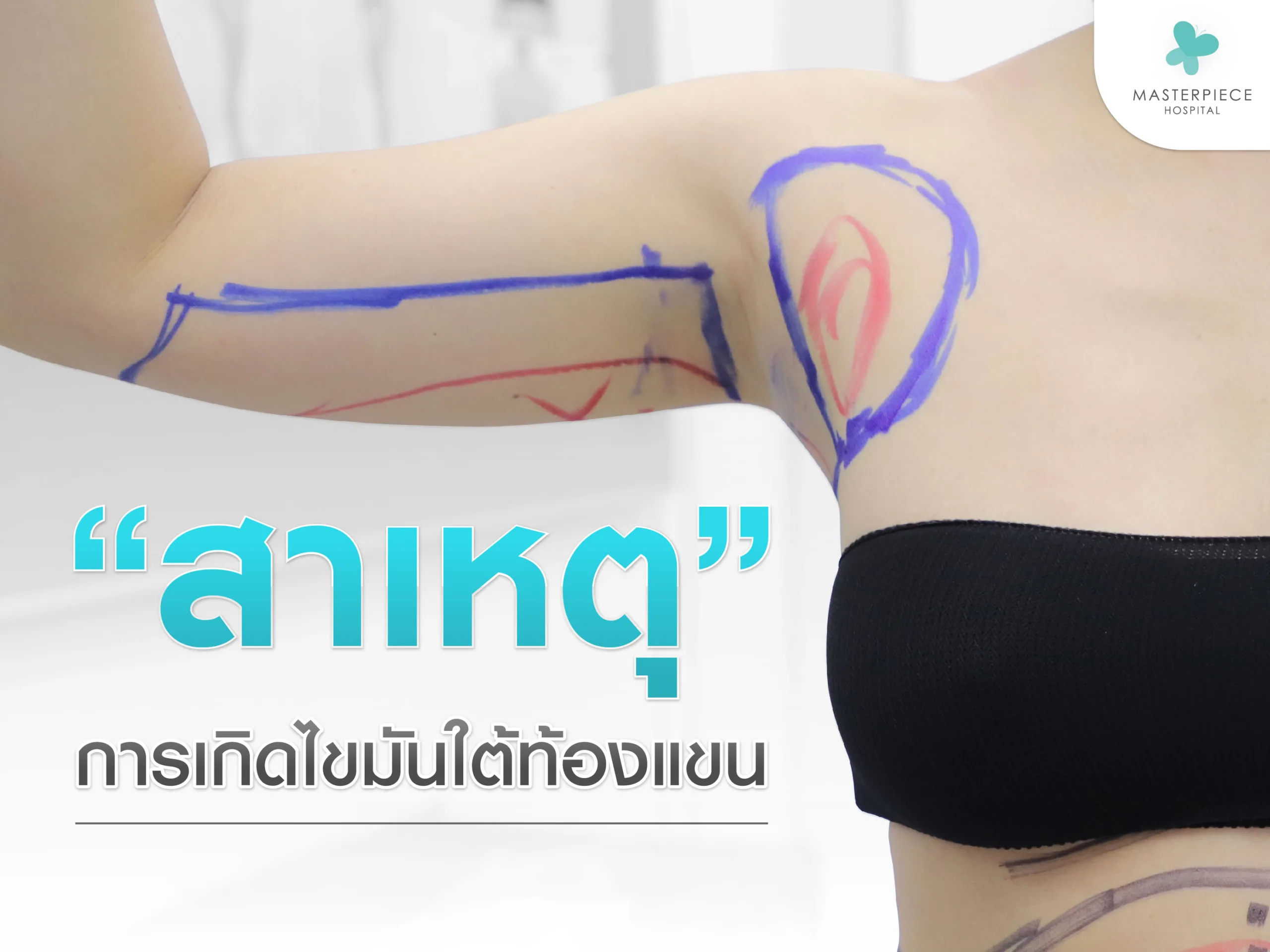 สาเหตุของการเกิดไขมันใต้ท้องแขน