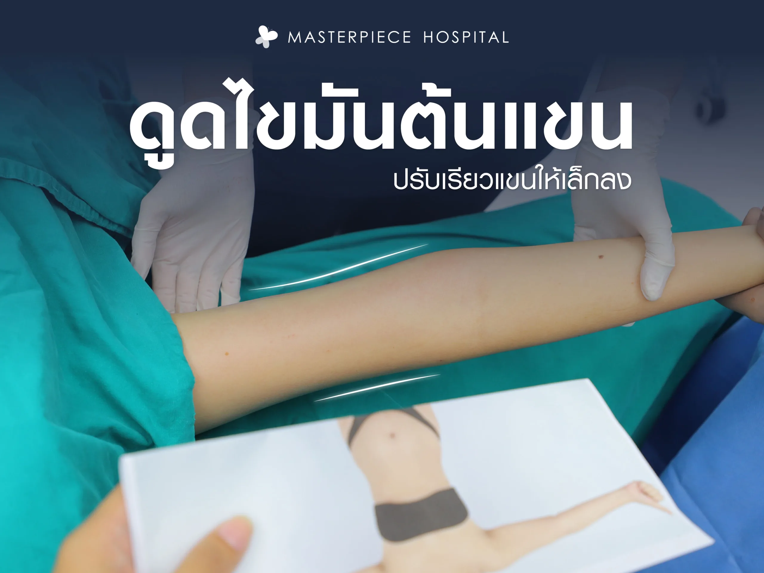 การดูดไขมันต้นแขนปรับเรียวแขนให้เล็กลง