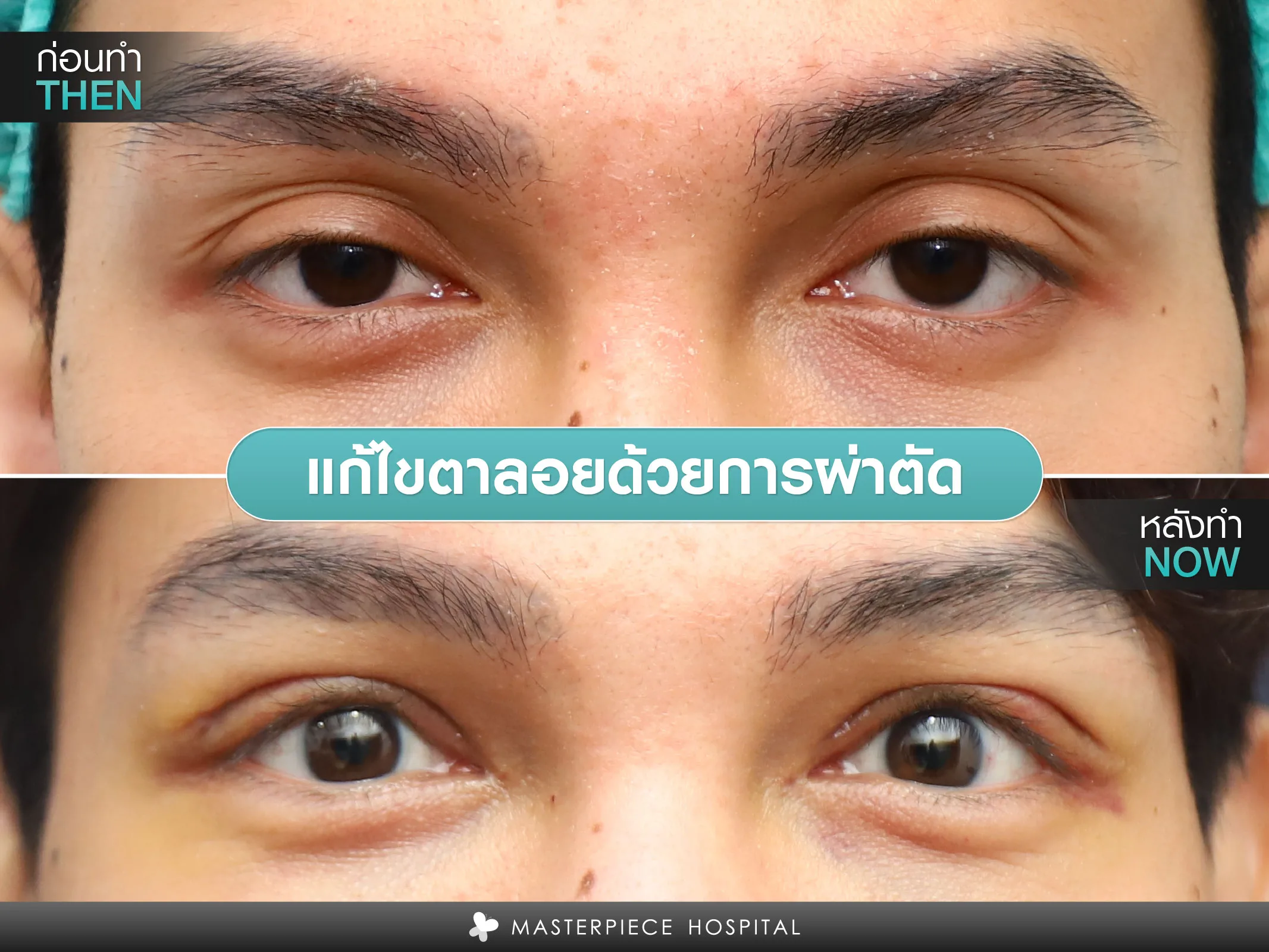แก้ตาลอยด้วยการผ่าตัด