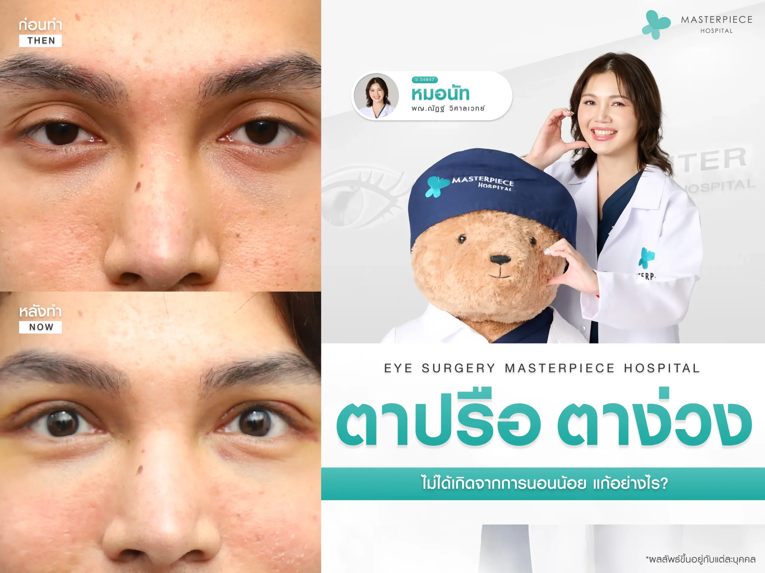 ตาปรือตาง่วง