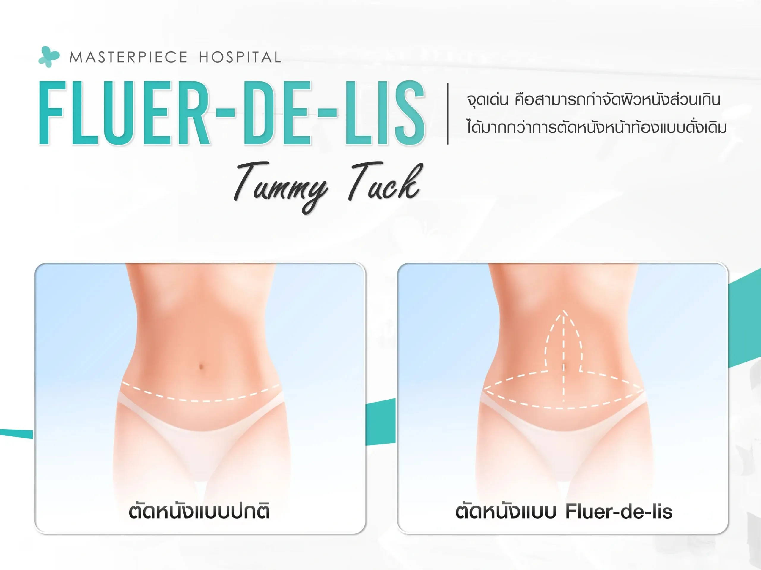 จุดเด่นของ Fleur-de-lis Tummy Tuck