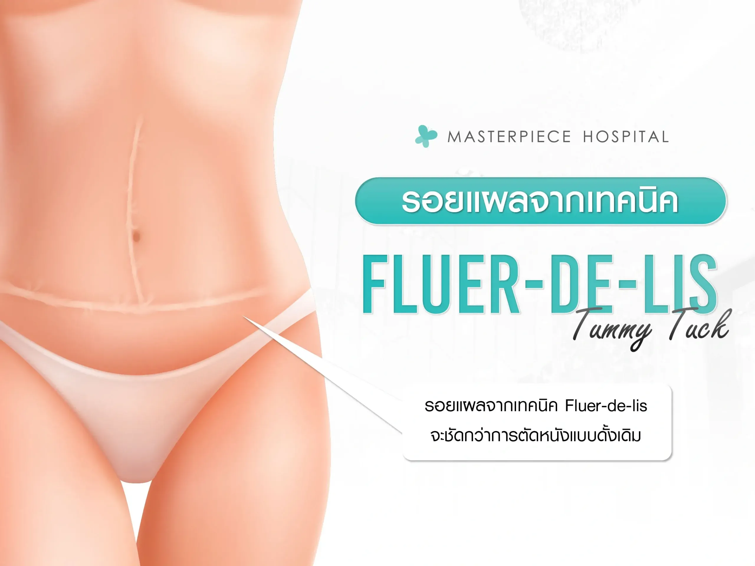 รอยแผลจากเทคนิค Fleur-de-lis Tummy Tuck เป็นอย่างไร