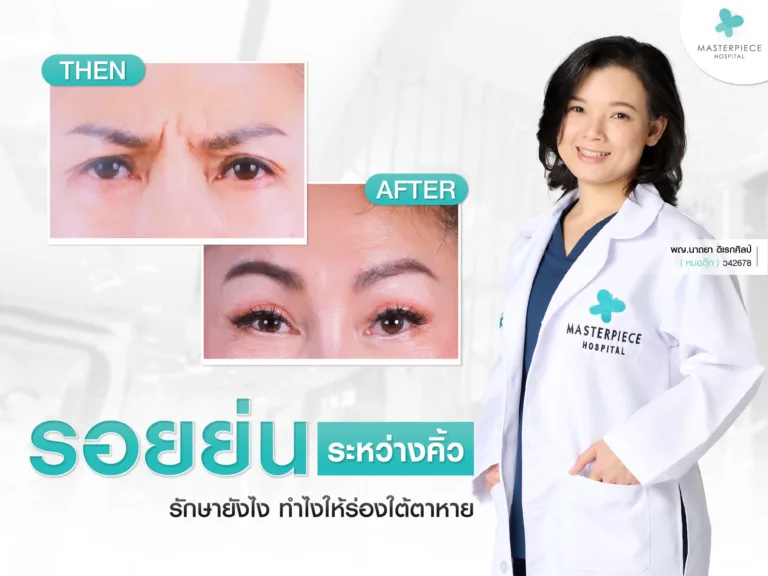รอยย่นระหว่างคิ้ว ริ้วรอยย่น รักษายังไง
