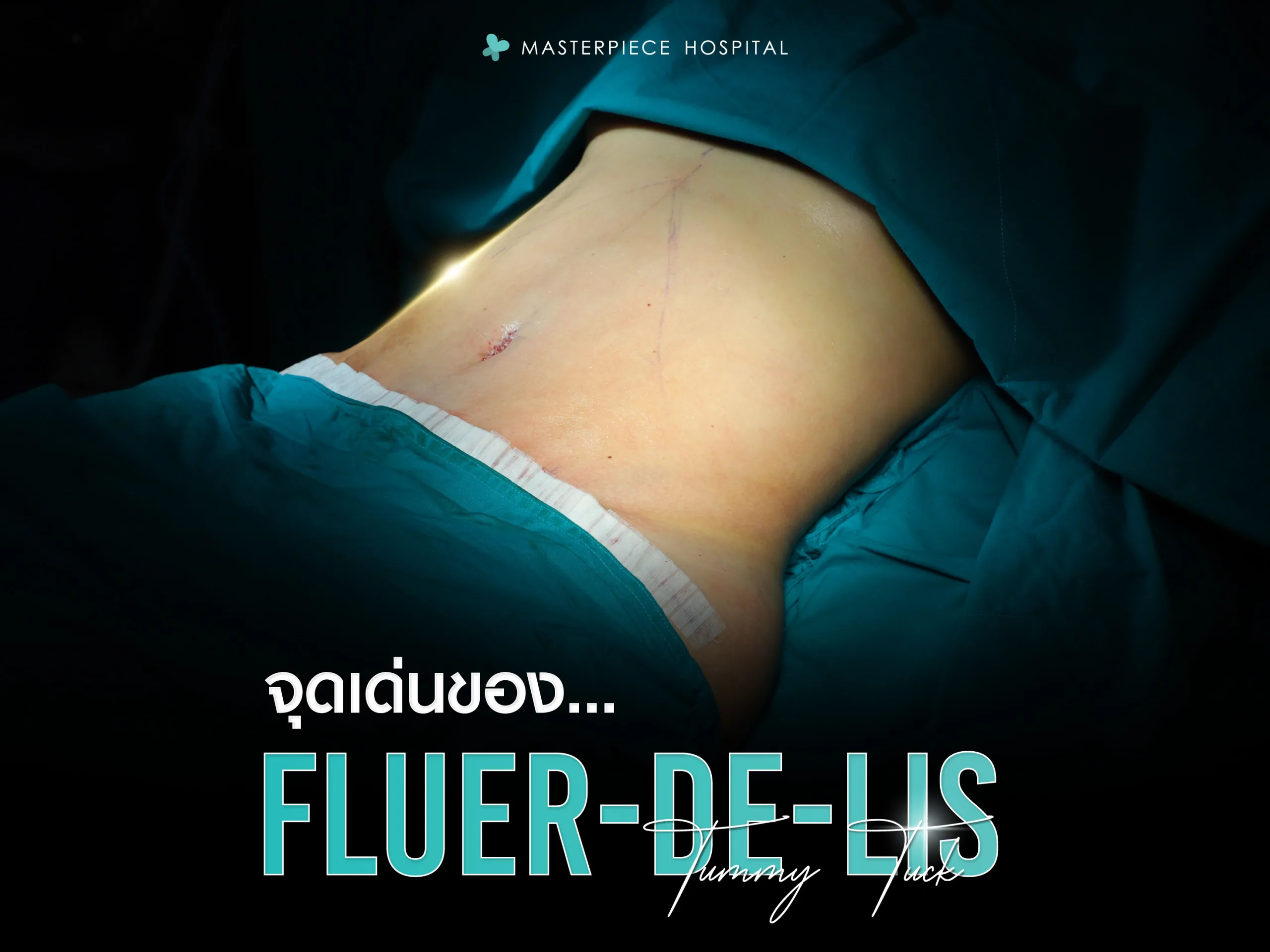 จุดเด่นของ Fleur-de-lis Tummy Tuck