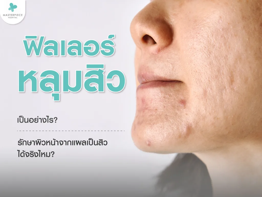 ฟิลเลอร์หลุมสิวเป็นอย่างไร รักษาผิวหน้าจากแผลเป็นสิวได้จริงไหม