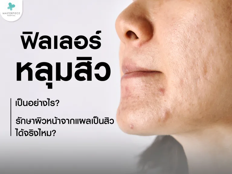 ฟิลเลอร์หลุมสิวเป็นอย่างไร รักษาผิวหน้าจากแผลเป็นสิวได้จริงไหม